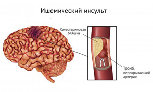 тромб в сосуде мозга