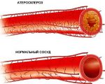 Что такое атеросклероз брюшного отдела аорты, и чем он опасен?