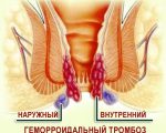 Геморроидальный тромбоз