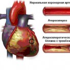 Закупорка сердечной артерии