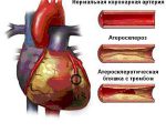 Причины атеросклероза коронарных артерий, и методы его лечения