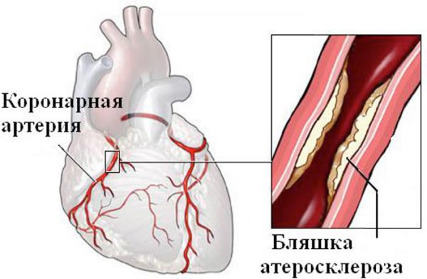 Поражение коронарных артерий атеросклерозом