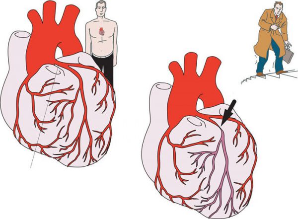 Одной из причин стенокардии, может быть спазм сердца