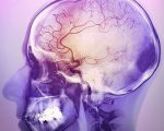 Причины и лечение хронической ишемической болезни головного мозга