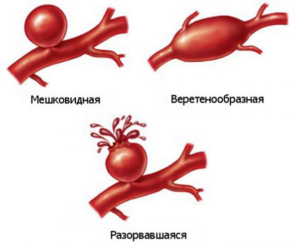 Виды аневризм аорты