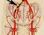 Что такое окклюзия подвздошных артерий и чем она опасна?