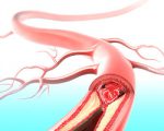 Признаки и лечение окклюзии коронарных артерий
