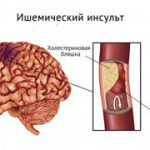 Ишемический инсульт мозга: опасный недуг, но не приговор