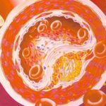 Атеросклероз аорты – полная информация о заболевании