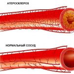 Атеросклероз брюшной аорты