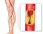 Атеросклероз нижних конечностей симптомы