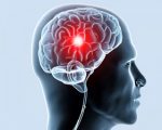 Симптомы и лечение ишемии сосудов головного мозга