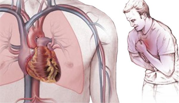 При тахикардии возрастает риск ишемии сердца и других органов