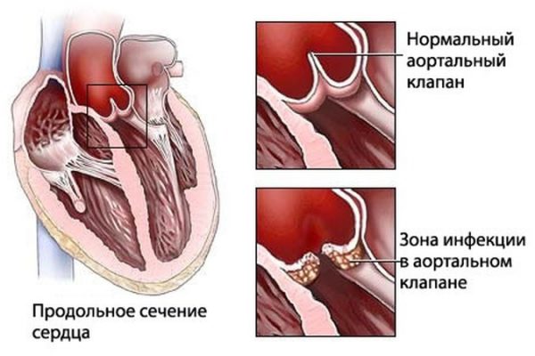 Инфекция в аортальном клапане