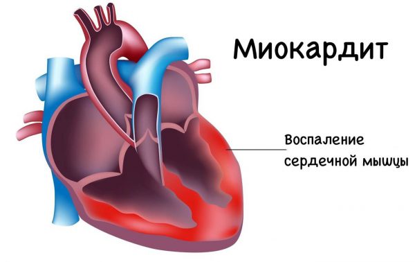 Учащение сердечного пульса может привести к миокардиту