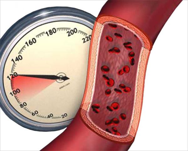 Степени гипертонии различаются по величине артериального давления