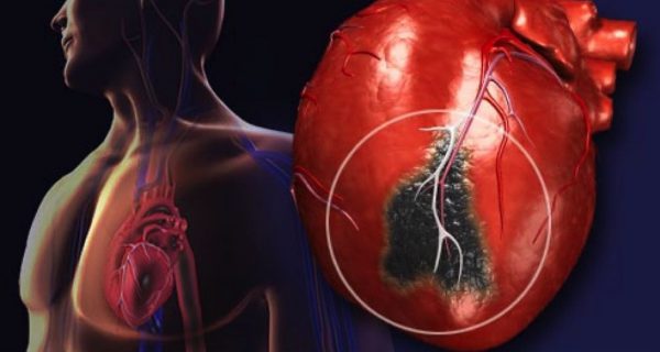 Стенокардия может привести к инфаркту миокарда