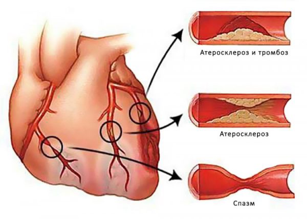 Причиной нестабильной стенокардии яяляется атеросклероз сердечных сосудов