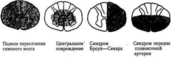 Диаграмма повреждений спинного мозга