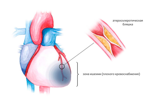 Плохой кровоток к сердцу может вызвать серьезные проблемы