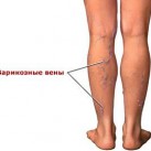 Варикозное расширение вен на ногах симптомы и лечение фото