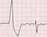 Причины и лечение экстрасистолии сердца
