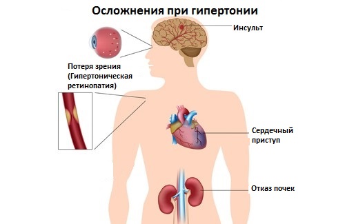 Повышенное артериальное давление (гипертония) 