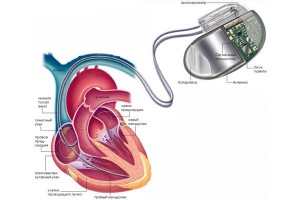 Подключение кардиостимулятора к сердцу