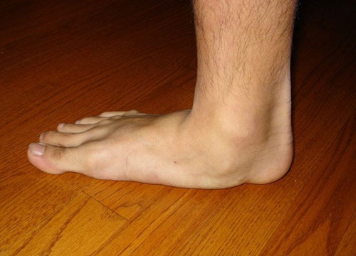 Плоскостопие ног