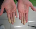 Поражение фаланг пальцев при синдроме Рейно